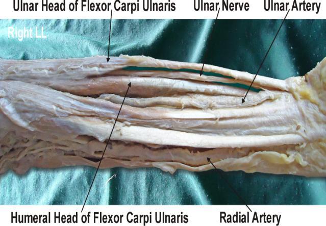 Figure - 2 : Photographic presentation of the right forearm showing separate ulnar and humeral heads of flexor carpi ulnaris muscle.