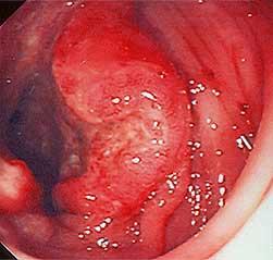 The common symptoms of large bowel disease are: Bleeding, Change in Bowel habit and/or Abdominal pain.
