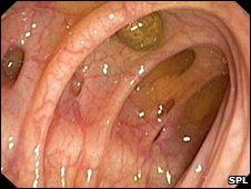 s disease, Ulcerative colitis), narrowing (strictures and cancer), or weakness (diverticular disease)