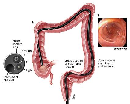 What does a Colonoscopy involve? The colonoscope is a thin, flexible tube that ranges from 48 in. (122 cm) to 72 in. (183 cm) long.