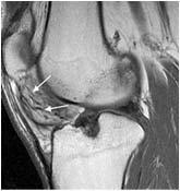 after original procedure if extension loss >10 or flexion < 120 Manipulation under anaesthesia: short lever arms in my