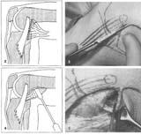 Open release: Usually for significant extension deficits (>15 20 degrees) Combined arthroscopic and open procedure Technique as described by Lobenhoffer et al: (Lobenhoffer HP et al.