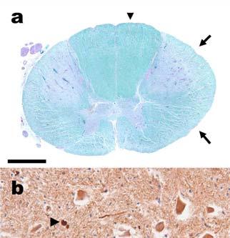 Figure (E)F-2. Axonal degeneration and neuronal inclusions in the spinal cord in NIFID.