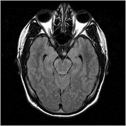 Neurocarcoidosis: Temporal profile There are other patients for whom the course of the disease follows a temporal pattern that appears to be relapsing and remitting similar to an immunological