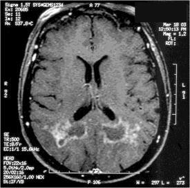 These forms may affect white matter, grey matter or it may produce tumor-like lesions.