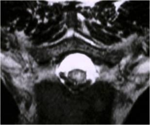 Neurosarcoidosis: Myelopathic form MRI s Neurosarcoidosis in the spinal cord is very aggressive and