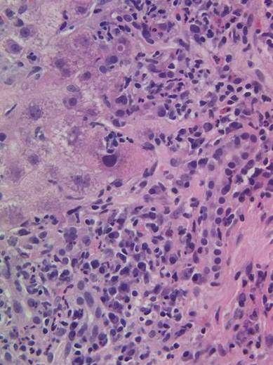 Histological features of AIH Interface hepatitis ++ plasma cells Portal inflammation Spotty necrosis: