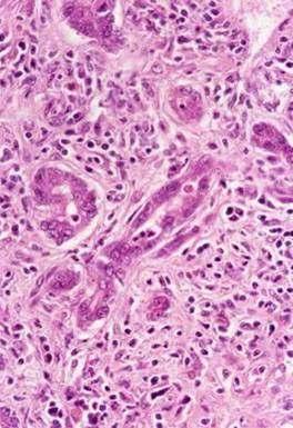 Histological features of AIH Interface hepatitis ++ plasma cells Portal inflammation Spotty necrosis: apoptotic bodies Confluent