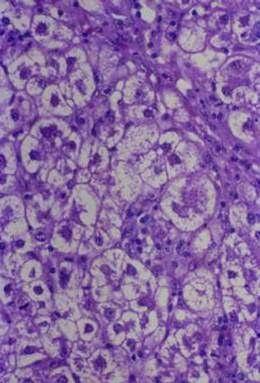 Histological features of AIH Multinucleated hepatocytes Perivenular