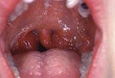 predisposition, large palatal tonsils, xiii oral trauma, xiv brain injury, xv allergies, xvi or macroglossia.