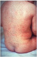 Rubella IgM Often the first result available Should be done concurrently with PCR Serum required May be undetectable if serum collected within first five days of rash onset Second serum specimen