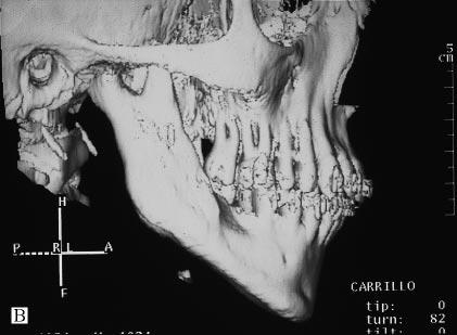 Table 1 Mandibular : treatment planning unilateral mandibular was not considered an associated maxillary deformity necessarily requiring treatment.