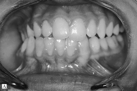 Intraoral mandibular distraction osteogenesis 259 Fig. 3 Dental occlusion (of patient depicted in Figs 1 and 2). (A) Preoperatively; note the lateral cross bite on the right (hypoplastic) side.