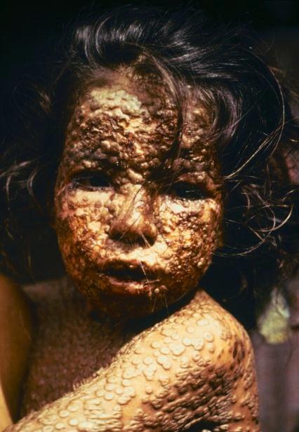 Smallpox Scourge of humanity for thousands of years Distinctive rash Highly infectious Kills 1 in 3 infected people