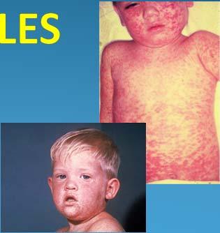 Measles Highly contagious and the virus remains active and contagious in the air or on infected surfaces for up to 2 hours, is a leading causes of death among young children Among unimmunized, 90% of