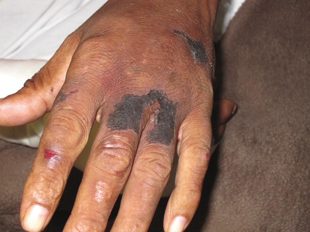 The second patient is a 52-year-old male with medical history of constant crack cocaine and marihuana abuse, complaining of bilateral upper and lower extremities necrotic skin lesions, which were
