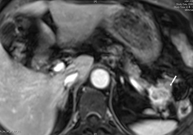 Korean Journal of HBP Surgery Vol. 15, No. 2, 2011 tomy with segmental resection of whole splenic vessels. The tumor was reported as a serous cystadenoma (Fig. 1B, C).