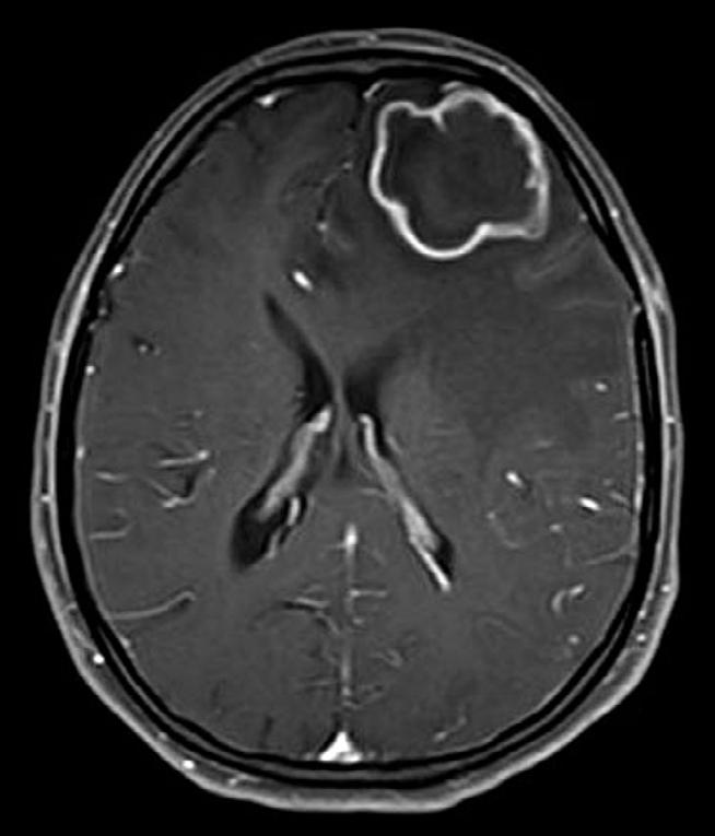 (a) Non-contrast CT scan of head revealed an irregular cystic mass with concentric slightly thick wall in the left frontal lobe