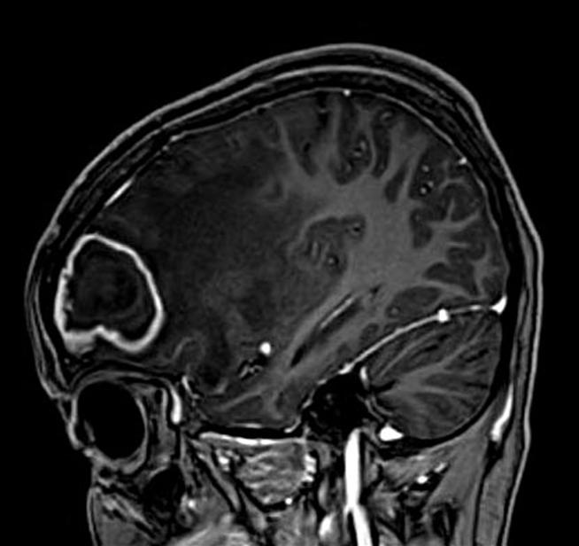 (b, c) T1 weighted axial (b) and T2 weighted axial (c) delineate lobulated outline mass in left frontal lobe in anterior aspect