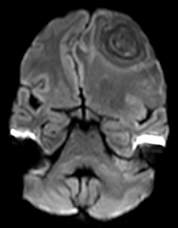 Tumor-like Presentation of Tubercular Brain Abscess Dan B. Karki, et al. g h i Fig. 1. (g, h) DWI - b1000 (g) and DWI - ADC map (h) show no restricted diffusion was seen within this mass in DWI.