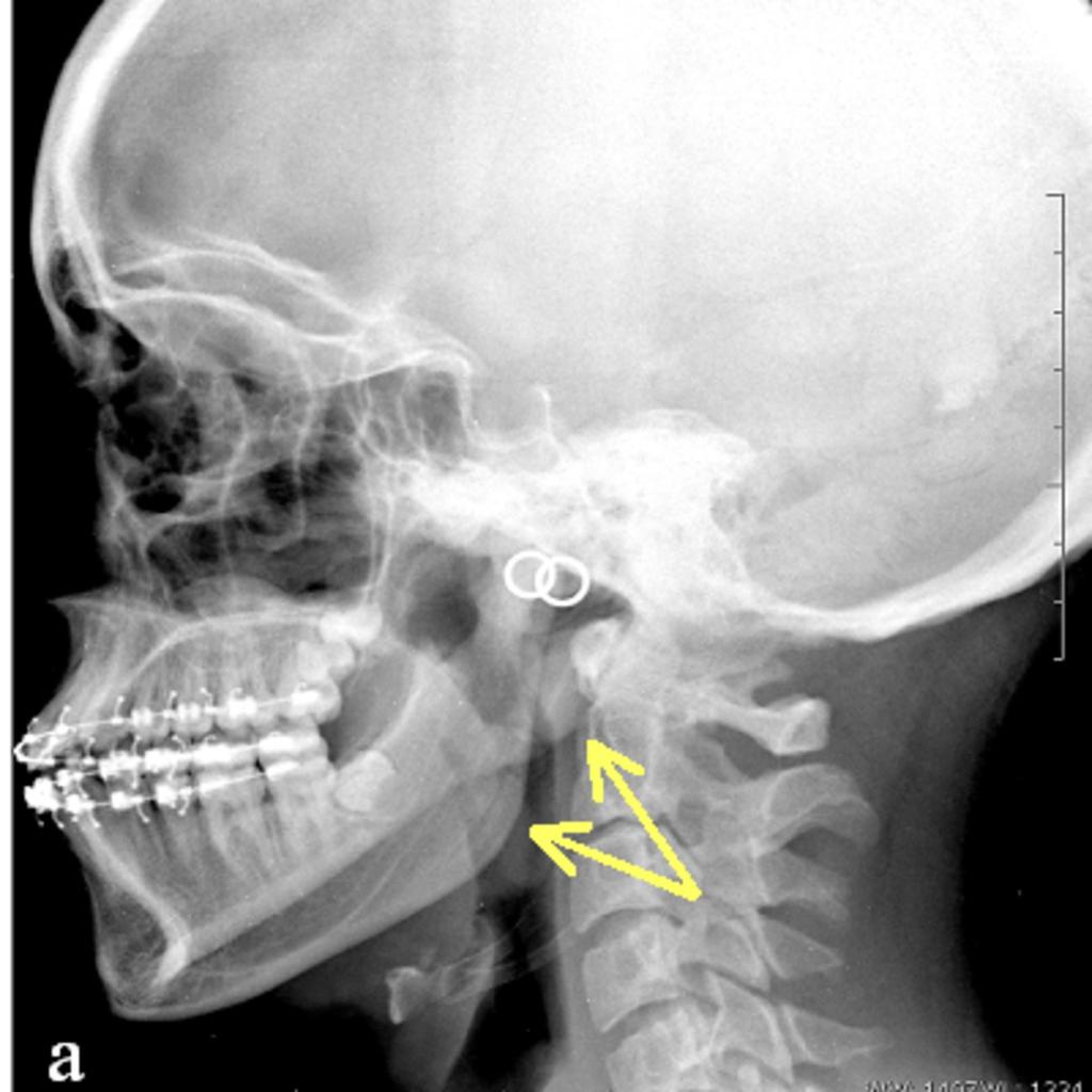 Fig. 1: 16 year-old girl with left side hemifacial microsomia.