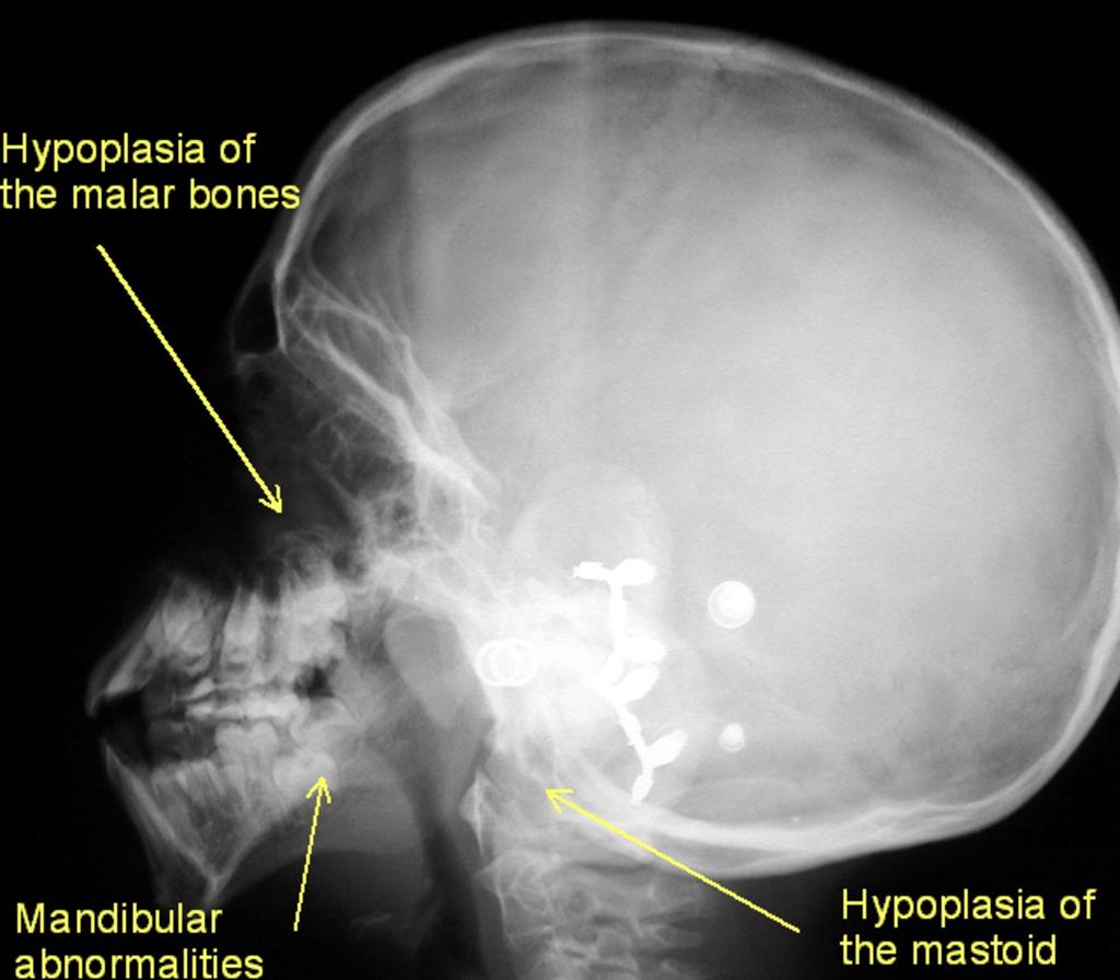 Fig. 4: Mandibulofacial dysostosis ( Treacher Collins syndrome).