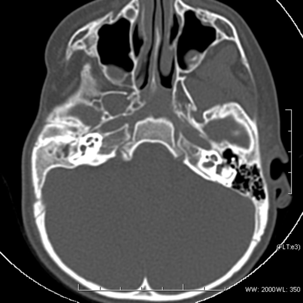 Fig. 8: External and middle ear abnormalities: 16 year old girl with right hemifacial microsomia.