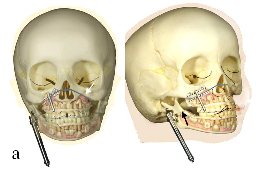 Fig. 13: Application of the maxillary distractor and the mandibular distractor after performing the Le Fort