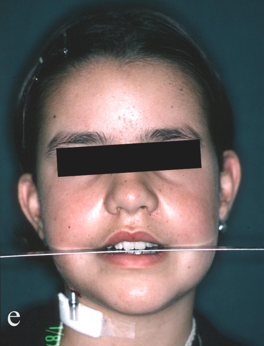 Fig. 17: Same patient, post osteogenesis by double maxillo-mandibular elongation.