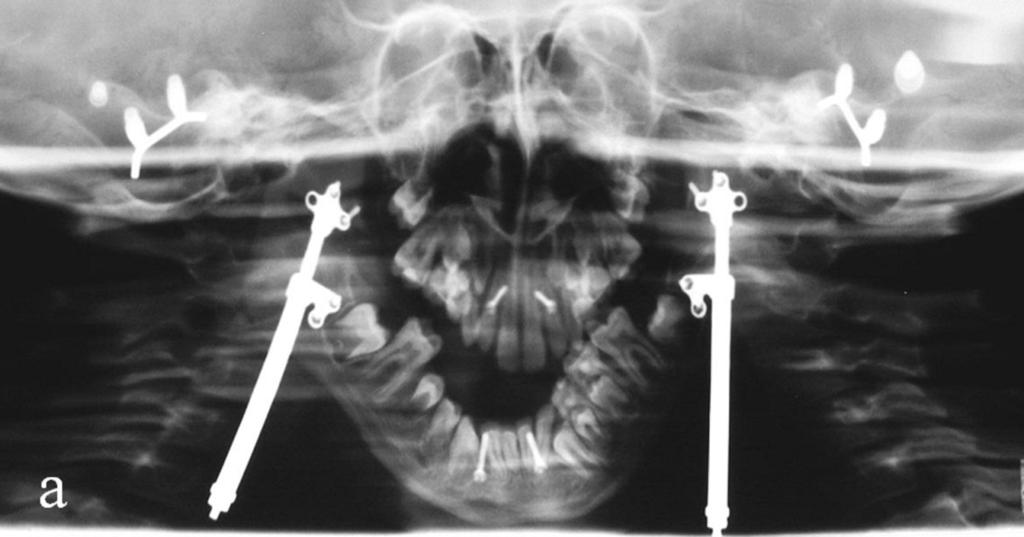 Fig. 18: Bilateral external ear aplasia in