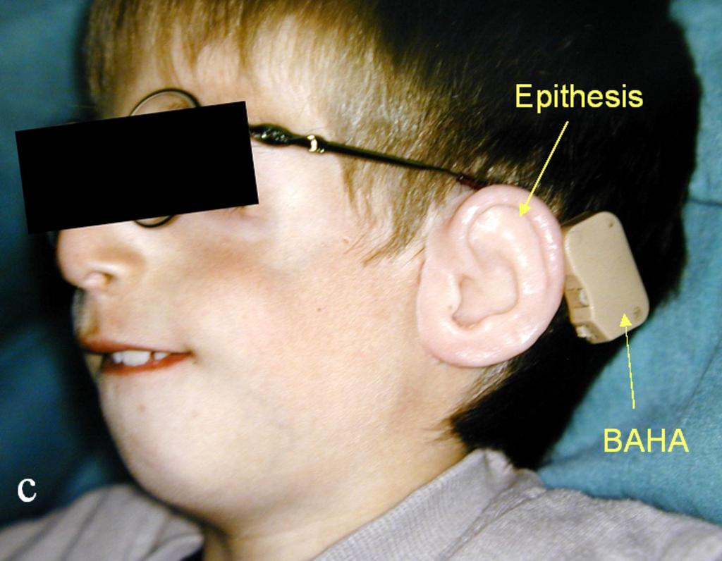 Fig. 19: Ear epithesis. same patient in figure 23. Transcutaneous abutments of two temporal fixatures.