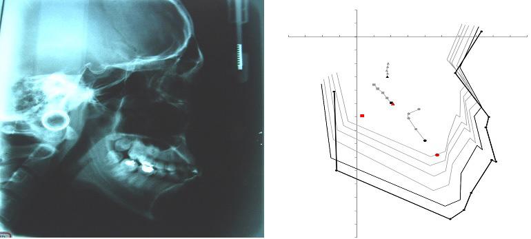 Figure 3: Panoramic film before active treatment The radiographic methods of the research include intraoral photos,