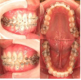 Treatment Objectives Our treatment objectives were (1) to remove functional interference over bilateral maxillary second molar regions, (2) to improve facial profile, (3) to establish