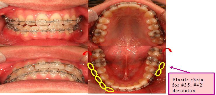 11, for better torque control of #17, #27 region, reinforced crown lingual torque and Trans palatal IME were performed and #37, #47 crown buccal torque was added (Figure.8).