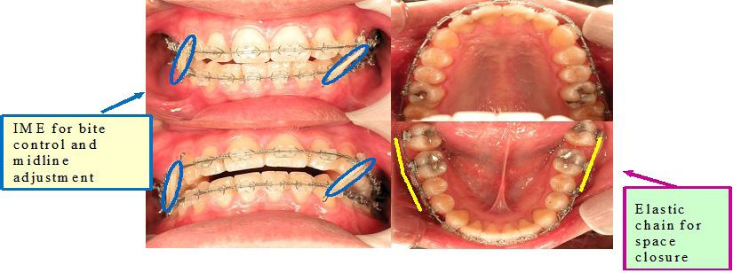 07.13, after 3 months of active treatment, intermaxillary elastics (3/16M) were added to facilitate bite control, and at the same time, for midline adjustment (Figure.9).