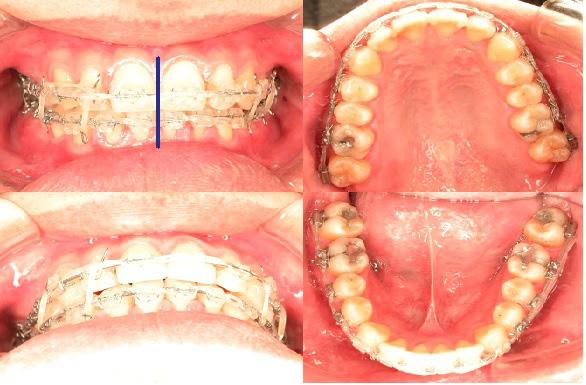 4 Figure 12: Facial photos after active treatment Figure