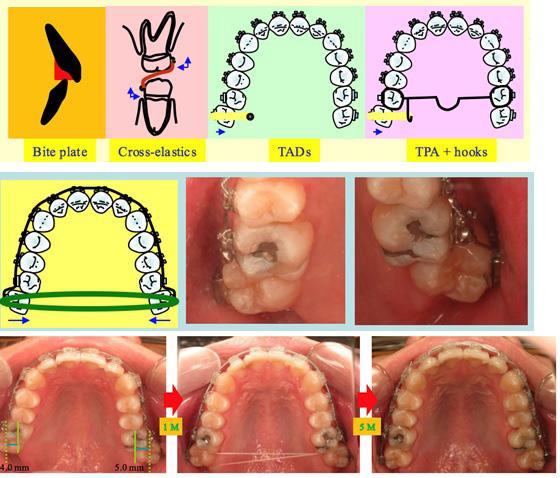 Buccoversion correction There are many methods to help correct buccoversions, such as bite plate, cross-elastics, transpalatal-arch with extension hooks, TADs, etc.