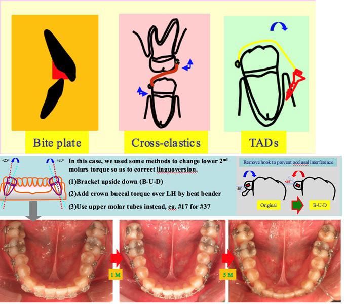 Linguoversion correction There are many methods to help correct linguoversions, such as bite plate, cross-elastics, TADs, etc.