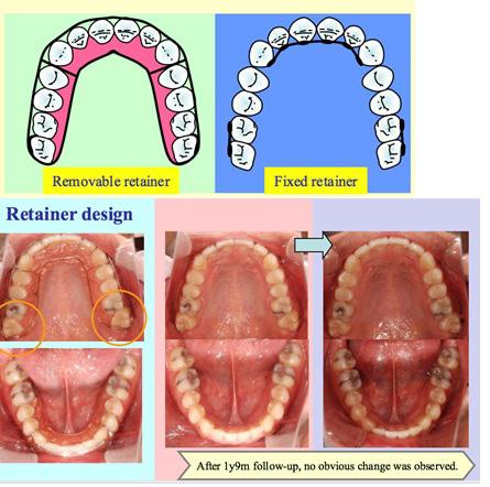 Retention We can use either removable retainers or fixed retainers to maintain the treatment result.