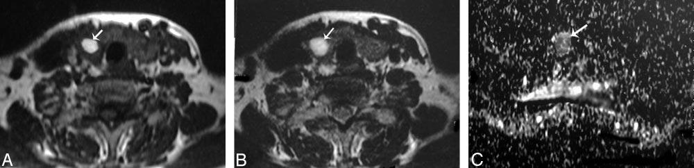 A and B, Axial T1- and T2-weighted MR images, respectively, showing a small well-defined more or less rounded solitary nodule (arrow) affecting the right thyroid lobe.