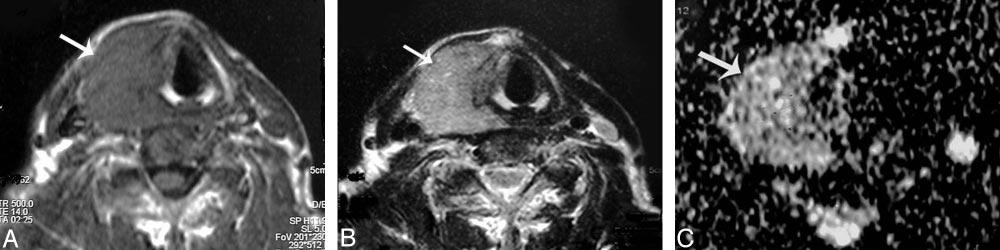 Papillary carcinoma of the thyroid.