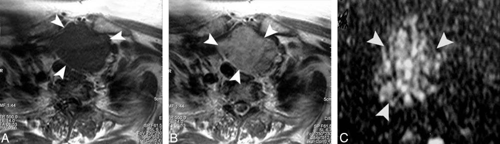 Fig 7. Follicular carcinoma of the thyroid.