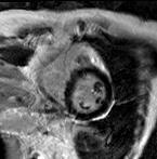 Pericardial Delayed Enhancement Imaging with