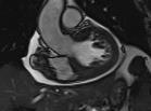Pericardial Effusion Detected on CMR, CMR detects