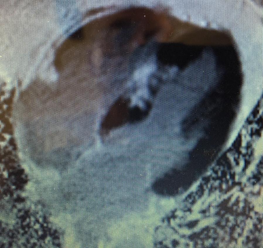 Identification of Myocardial Scar Normal myocardium appears black Gadolinium (Gd) is taken up in the spaces