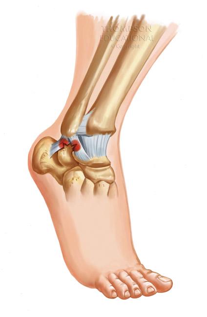 Ankle Joint Injuries Inversion sprains v twisted ankle Eversion sprains v Occurs to the deltoid v Pott s Fracture A force on