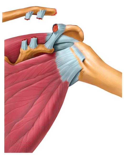 Shoulder Joint Injuries Biceps tendinitis v Caused by overuse of the biceps brachii muscle Shoulder separation v Tearing of the acromioclavicular