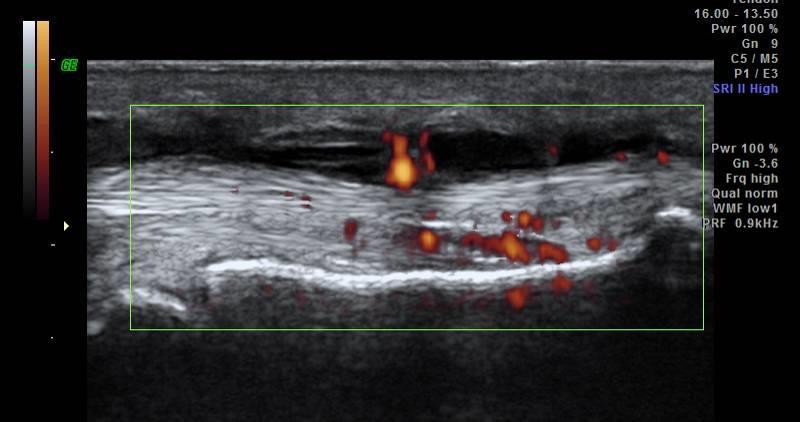 Tenosynovitis Hypoechoic or anechoic thickened tissue with or without fluid within the tendon