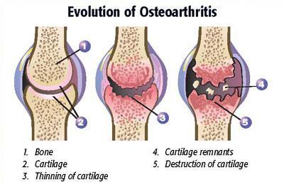 Osteoarthritis Introducing arthritis Cartilage thins Extra bone forms Hips,