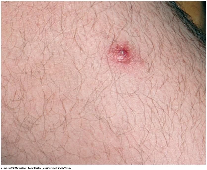 Contagious Skin Disorders! Boils (AKA: furuncles) Local staph infection of the skin that occur one at a time.